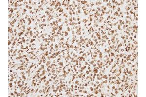 IHC-P Image Immunohistochemical analysis of paraffin-embedded TOV-21G xenograft, using ORC6L, antibody at 1:500 dilution. (ORC6 anticorps  (C-Term))