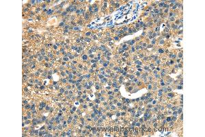 Immunohistochemistry of Human ovarian cancer using DHCR24 Polyclonal Antibody at dilution of 1:40 (Seladin 1 anticorps)
