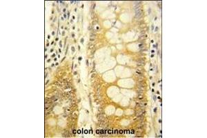 Formalin-fixed and paraffin-embedded human colon carcinoma reacted with LGALS2 Antibody (Center), which was peroxidase-conjugated to the secondary antibody, followed by DAB staining. (Galectin 2 anticorps  (AA 85-111))