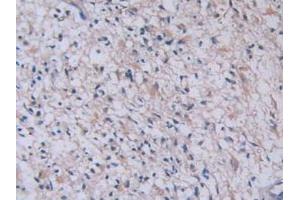 Detection of TPS in Human Glioma Tissue using Monoclonal Antibody to Tryptase (TPS)