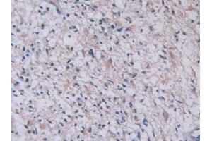 Detection of TPS in Human Glioma Tissue using Monoclonal Antibody to Tryptase (TPS) (TPSAB1 anticorps  (AA 161-262))