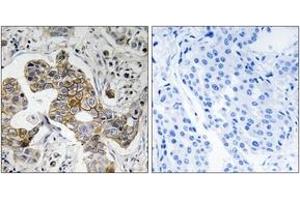 Immunohistochemistry analysis of paraffin-embedded human breast carcinoma tissue, using KCNK15 Antibody. (KCNK15 anticorps  (AA 273-322))