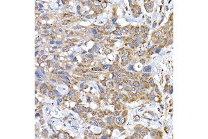 Immunohistochemistry of paraffin-embedded human esophageal cancer using SRP72 Rabbit pAb (ABIN6134166, ABIN6148452, ABIN7101299 and ABIN7101300) at dilution of 1:100 (40x lens).