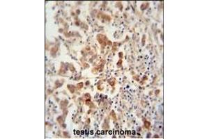TEX13B antibody (C-term) (ABIN654849 and ABIN2844514) immunohistochemistry analysis in formalin fixed and paraffin embedded human testis carcinoma followed by peroxidase conjugation of the secondary antibody and DAB staining. (TEX13B anticorps  (C-Term))