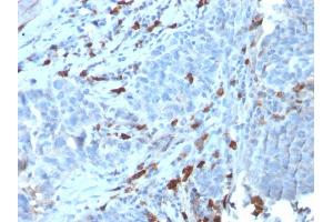 Formalin-fixed, paraffin-embedded human Tumor stained with IgM Recombinant Rabbit Monoclonal Antibody (IGHM/3135R). (Recombinant IGHM anticorps)