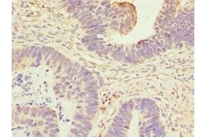 Immunohistochemistry of paraffin-embedded human ovarian cancer using ABIN7144326 at dilution of 1:100
