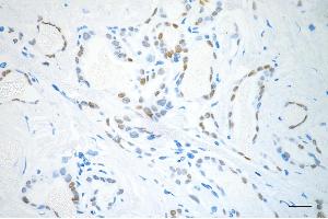 Immunohistochemistry was performed on paraffin-embedded human papillary thyroid carcinoma using NK2 homeobox 1 antibody (ABIN7799607), 1:200). (Recombinant NKX2-1 anticorps)