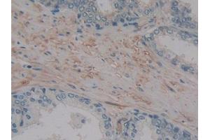 DAB staining on IHC-P; Samples: Human Prostate Tissue (MMP14 anticorps  (AA 322-541))