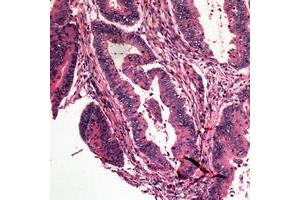 Immunohistochemical analysis of Caspase 10 staining in human colon cancer formalin fixed paraffin embedded tissue section.