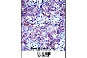 MMP13 Antibody immunohistochemistry analysis in formalin fixed and paraffin embedded human breast carcinoma followed by peroxidase conjugation of the secondary antibody and DAB staining. (MMP13 anticorps  (AA 253-282))