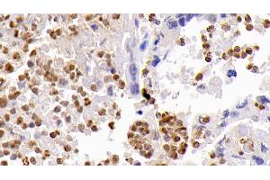 Detection of CASP3 in Human Lung cancer Tissue using Monoclonal Antibody to Caspase 3 (CASP3) (Caspase 3 anticorps  (AA 29-175))