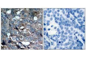 Immunohistochemical analysis of paraffin-embedded human breast carcinoma tissue using ASK1 (phospho-Ser83) antibody (E011178). (ASK1 anticorps  (pSer83))