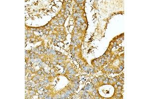 Immunohistochemistry of paraffin-embedded Human colon carcinoma using CE antibody (ABIN7266084) at dilution of 100 (40x lens).