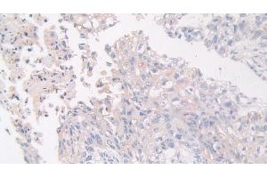 Detection of FLII in Human Lung cancer Tissue using Polyclonal Antibody to Flightless I Homolog (FLII)