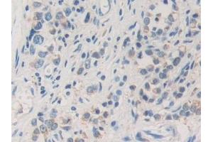 Detection of ACAT2 in Human Stomach cancer Tissue using Polyclonal Antibody to Acetyl Coenzyme A Acetyltransferase 2 (ACAT2)