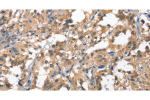Immunohistochemistry of paraffin-embedded Human thyroid cancer tissue using HGF Polyclonal Antibody at dilution 1:65 (HGF anticorps)
