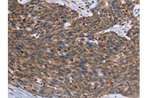 The image on the left is immunohistochemistry of paraffin-embedded Human cervical cancer tissue using ABIN7192846(TNPO1 Antibody) at dilution 1/25, on the right is treated with synthetic peptide. (Transportin 1 anticorps)