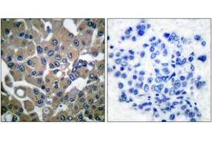 Immunohistochemistry analysis of paraffin-embedded human breast carcinoma, using PLCG1 (Phospho-Tyr783) Antibody. (Phospholipase C gamma 1 anticorps  (pTyr783))