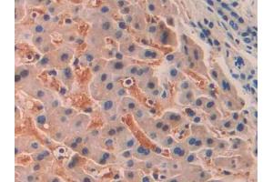 DAB staining on IHC-P; Samples: Human Liver cancer Tissue