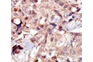 IHC analysis of FFPE human breast carcinoma tissue stained with the MLCK antibody (MYLK anticorps  (AA 908-938))