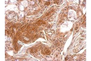 IHC-P Image TPK1 antibody detects TPK1 protein at cytosol on Cal27 xenograft by immunohistochemical analysis. (TPK1 anticorps)