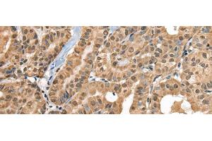 Immunohistochemistry of paraffin-embedded Human thyroid cancer tissue using RTCB Polyclonal Antibody at dilution of 1:30(x200) (C22orf28 anticorps)