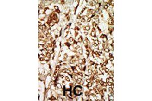 Formalin-fixed and paraffin-embedded human hepatocellular carcinoma tissue reacted with MOS polyclonal antibody  , which was peroxidase-conjugated to the secondary antibody, followed by AEC staining. (MOS anticorps  (N-Term))