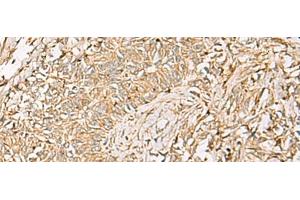 Immunohistochemistry of paraffin-embedded Human ovarian cancer tissue using QDPR Polyclonal Antibody at dilution of 1:70(x200) (QDPR anticorps)