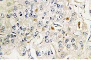 Immunohistochemistry (IHC) analyzes of VDR antibody in paraffin-embedded human breast carcinoma tissue. (Vitamin D Receptor anticorps)