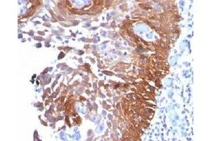IHC testing of cervical carcinoma stained with Cytokeratin 17 antibody. (KRT17 anticorps)