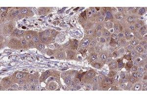 ABIN6276476 at 1/100 staining Human liver cancer tissue by IHC-P. (RHOC anticorps  (C-Term))