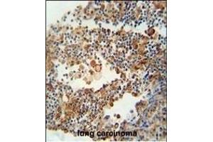 OR9Q1 antibody (C-term) (ABIN654850 and ABIN2844515) immunohistochemistry analysis in formalin fixed and paraffin embedded human lung carcinoma followed by peroxidase conjugation of the secondary antibody and DAB staining. (OR9Q1 anticorps  (C-Term))