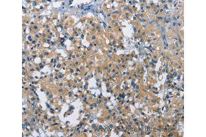 Immunohistochemistry of Human gastric cancer using BMPR1B Polyclonal Antibody at dilution of 1:30