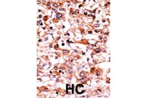 Formalin-fixed and paraffin-embedded human cancer tissue reacted with the primary antibody, which was peroxidase-conjugated to the secondary antibody, followed by AEC staining.
