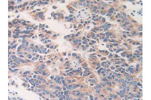 IHC-P analysis of Human Prostate Cancer Tissue, with DAB staining. (ETFB anticorps  (AA 2-255))