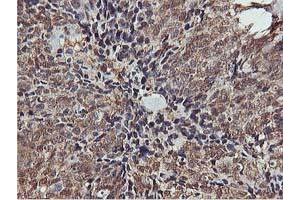 Immunohistochemical staining of paraffin-embedded Adenocarcinoma of Human breast tissue using anti-AKT1 mouse monoclonal antibody. (AKT1 anticorps)