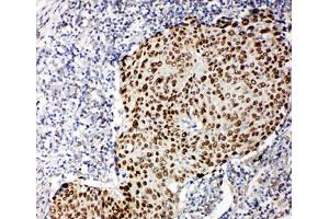 IHC-P testing of human lung cancer tissue (TCP1 alpha/CCTA anticorps  (AA 82-98))