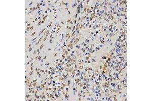 Immunohistochemistry of paraffin-embedded human lung cancer using TriMethyl-Histone H3-K79 antibody. (Histone 3 anticorps  (H3K79me3))