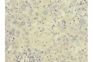 Immunohistochemistry of paraffin-embedded human liver cancer using ABIN7175581 at dilution of 1:100 (CACNA2D2 anticorps  (AA 20-200))