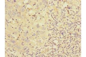 Immunohistochemistry of paraffin-embedded human liver cancer using ABIN7149008 at dilution of 1:100 (CSRP2 anticorps  (AA 1-193))
