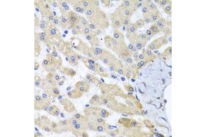 Immunohistochemistry of paraffin-embedded human liver injury using ABCB8 antibody. (ABCB8 anticorps)