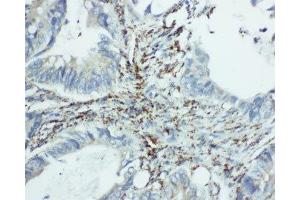 IHC-P: EIF6 antibody testing of human intestine cancer tissue (EIF6 anticorps  (Middle Region))