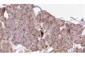 ABIN6273288 at 1/100 staining Human pancreas cancer tissue by IHC-P. (PCCA anticorps  (C-Term))