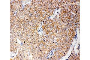 IHC-P: Caspase-12 antibody testing of human lung cancer tissue