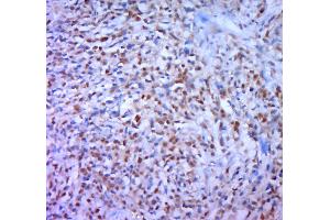 Paraformaldehyde-fixed, paraffin embedded human gastric carcinoma; Antigen retrieval by boiling in sodium citrate buffer (pH6. (DAXX anticorps  (pSer668))