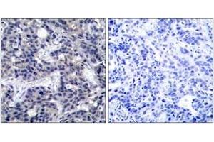Immunohistochemistry analysis of paraffin-embedded human breast carcinoma tissue, using PKR (Ab-446) Antibody. (EIF2AK2 anticorps  (AA 413-462))