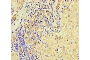 Immunohistochemistry of paraffin-embedded human liver cancer using ABIN7158401 at dilution of 1:100 (L1TD1 anticorps  (AA 665-865))