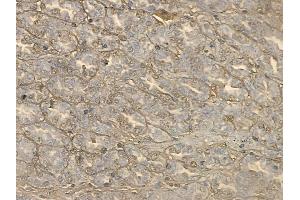 ABIN6264465 and ABIN6272654 at 1/100 staining human renal cell carcinoma by IHC-P. (PSG3 anticorps  (C-Term))