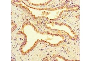 Immunohistochemistry of paraffin-embedded human prostate cancer using ABIN7168168 at dilution of 1:100 (RIOX2 anticorps  (AA 1-300))