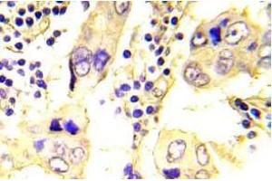 Immunohistochemistry (IHC) analyzes of SRC antibody in paraffin-embedded human breast carcinoma tissue. (NCOA1 anticorps)